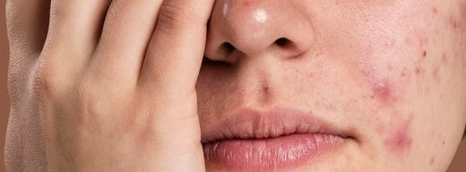 How to reduce acne: 13 effective tips that actually work