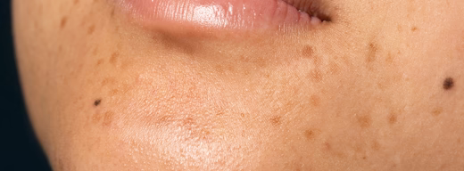 How to get rid of acne scars: Here’s everything you need to know