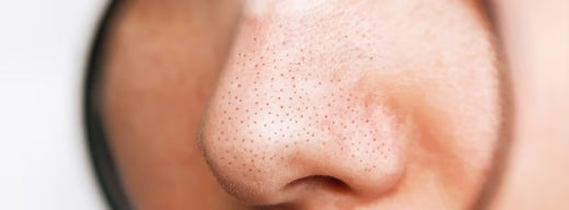 How to clear clogged pores in 5 easy ways