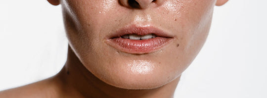 Does sweat cause acne?