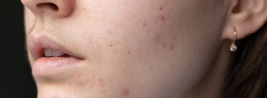 Winter acne: Tips to prevent cold weather acne 2023